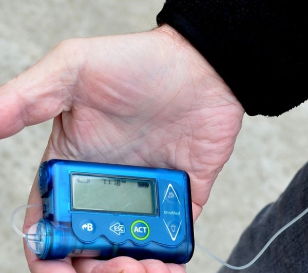 Eine Insulinpumpe kann auch Typ-2-Diabetikern helfen, ihre Therapie zu verbessern. 